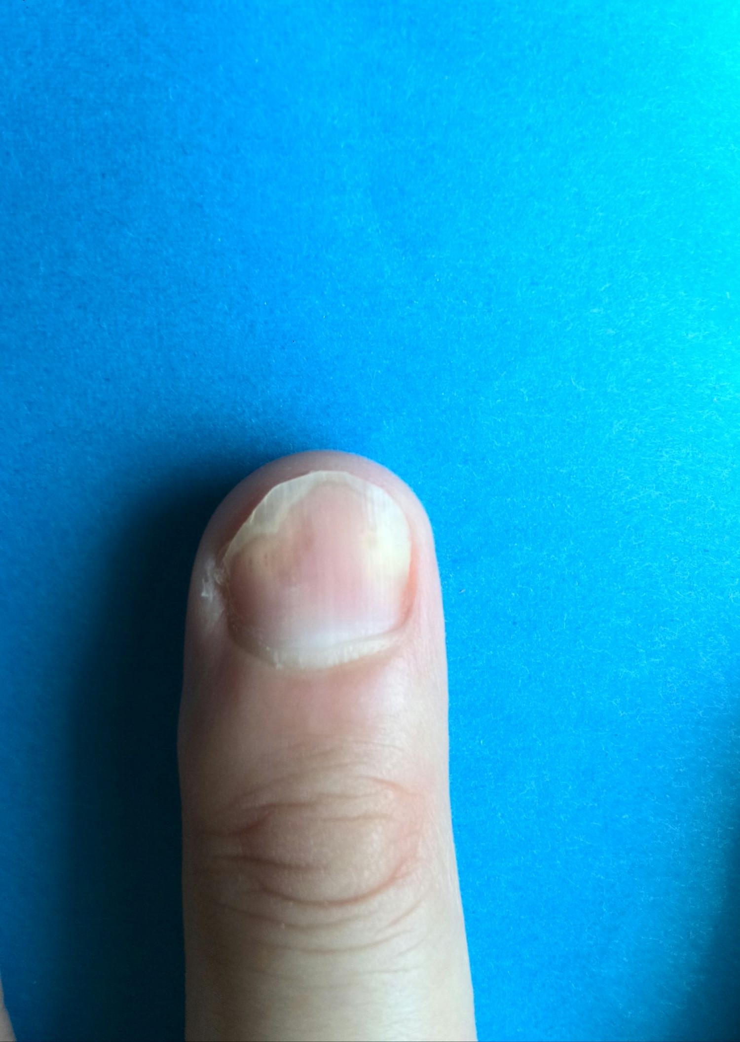 撮影 爪甲剥離症の右手中指の写真です もう 薬は塗らなくていい 爪が割れてきているのだけが心配です 爪甲剥離症 そうこうはくりしょう を治そう