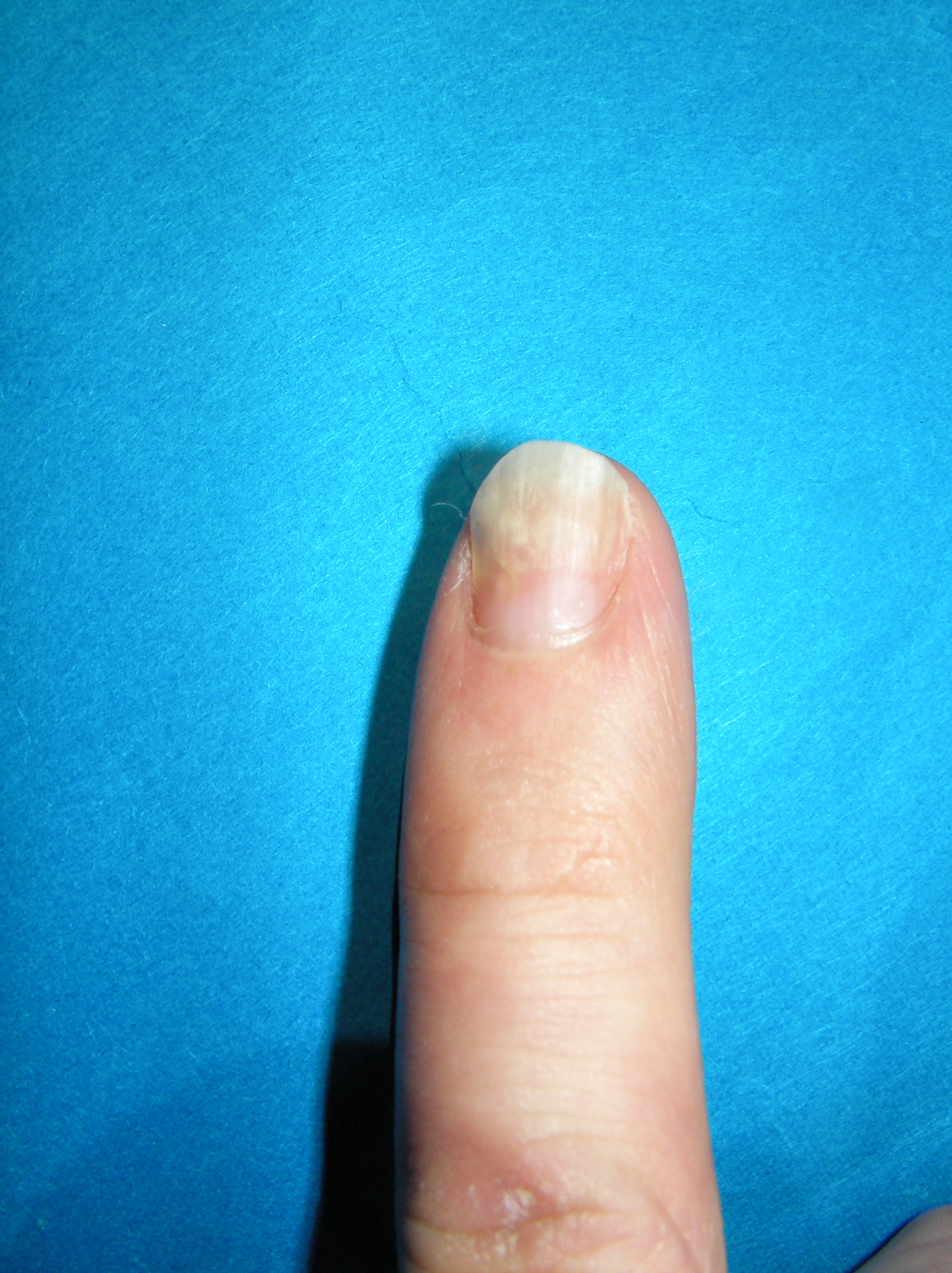 撮影 爪甲剥離症の左手小指の写真です フルメタローション使い切っても 一進一退ですな 爪甲剥離症 そうこうはくりしょう を治そう