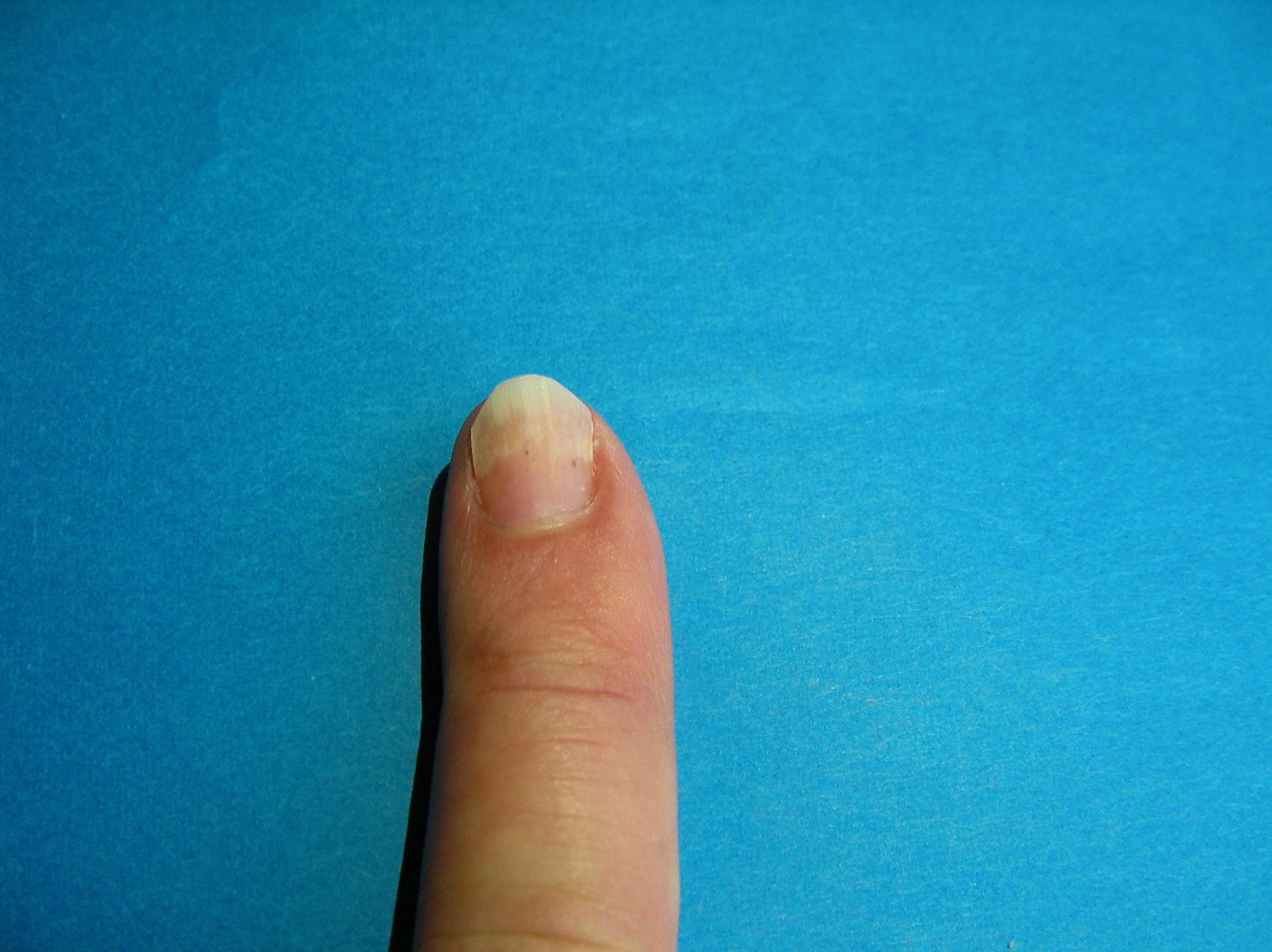 撮影 爪甲剥離症の右手小指の写真です 爪の穴は大きくなってきましたが 皮膚科医は もう少し様子をみましょう と 爪甲剥離症 そうこうはくりしょう を治そう