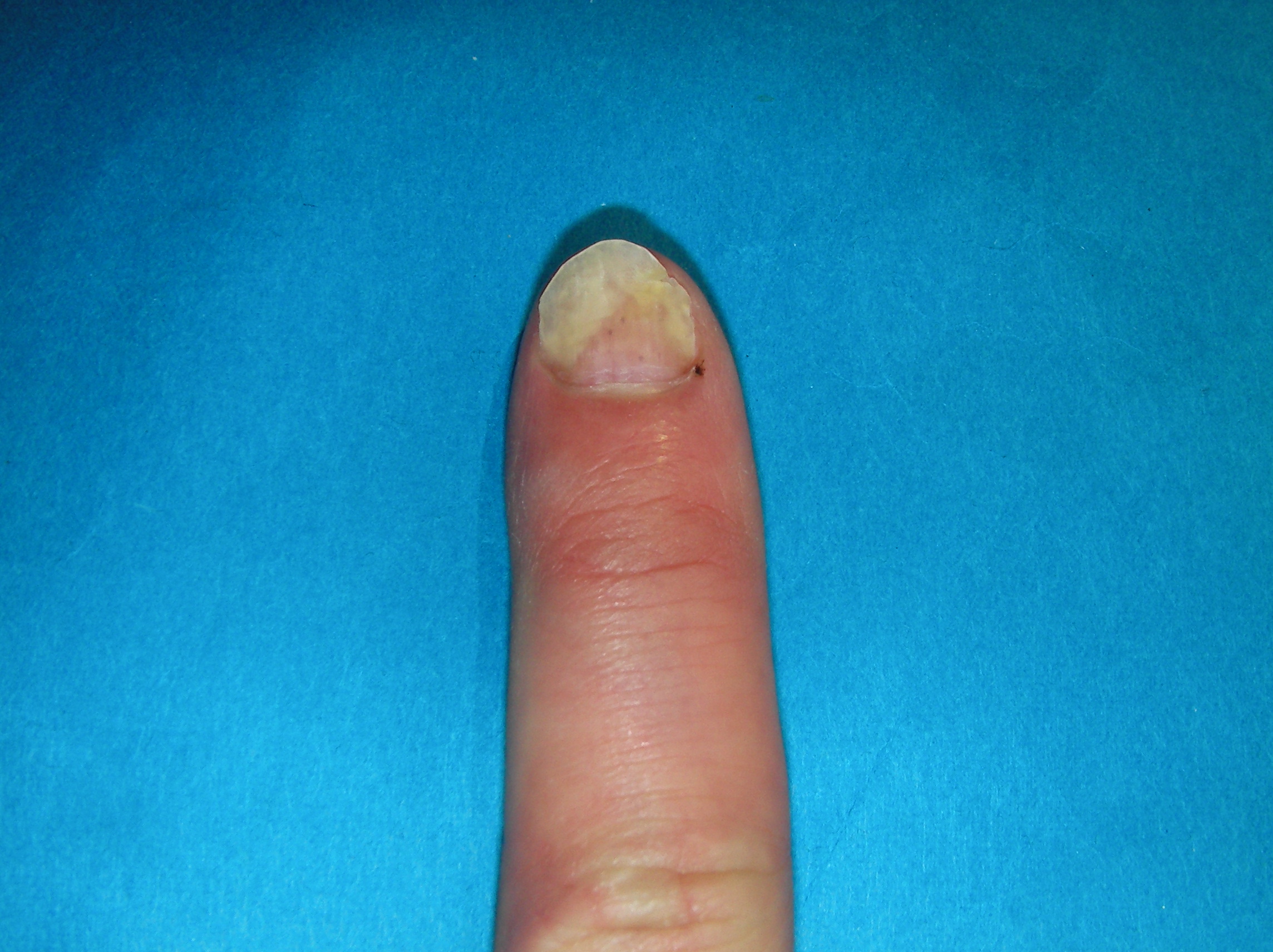 撮影 爪甲剥離症の左手人差し指の写真です ダメだ ピンクの三角の部分が減っている 爪甲剥離症 そうこうはくりしょう を治そう