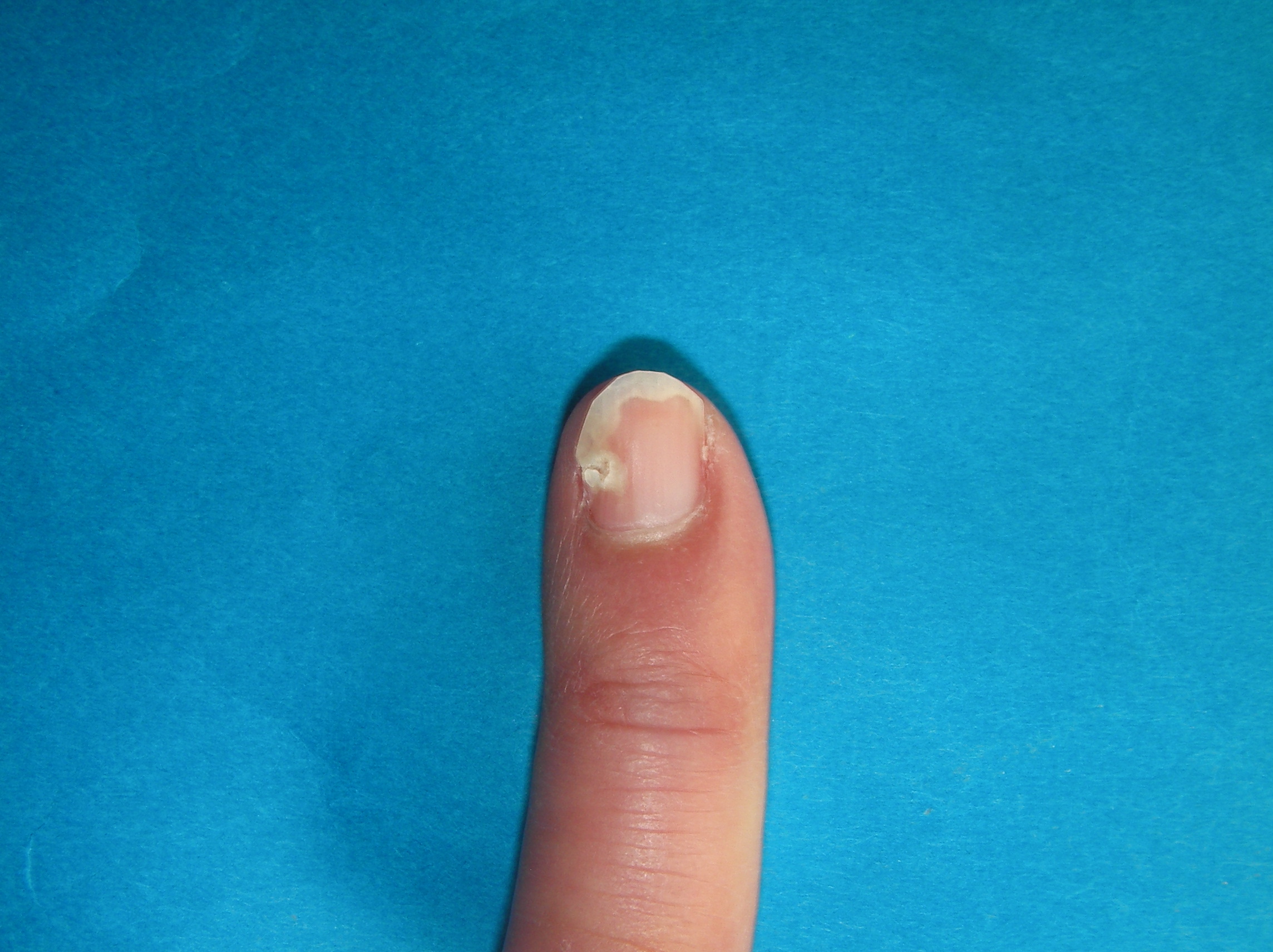 撮影 爪甲剥離症の右手小指の写真です 爪の穴は大きくなってきましたが 皮膚科医は もう少し様子をみましょう と 爪甲剥離症 そうこうはくりしょう を治そう
